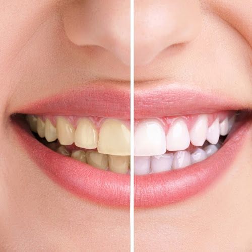 Brighter Teeth